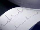 Ближайшие перспективы: помощь больным с нарушением ритма сердца
