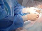 Для лечения хронической сердечной недостаточности в Западно-Сибирском медицинском центре ФМБА России применяется один из самых современных методов - имплантация ресинхронизирующих электрокардиостимуляторов. 
