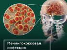 Что такое менингококковая инфекция?